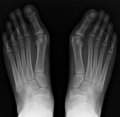 hallux valgus